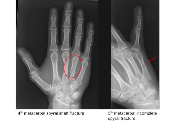 Metacarpal fractures